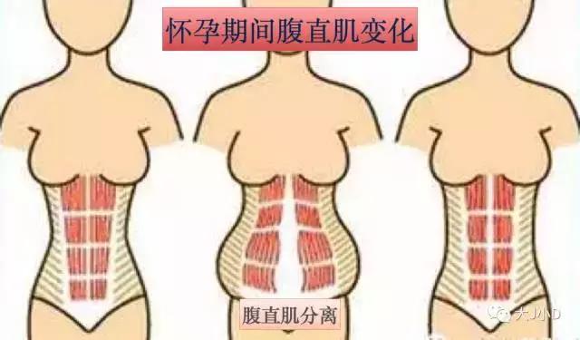 你的腹直肌分離了嗎？