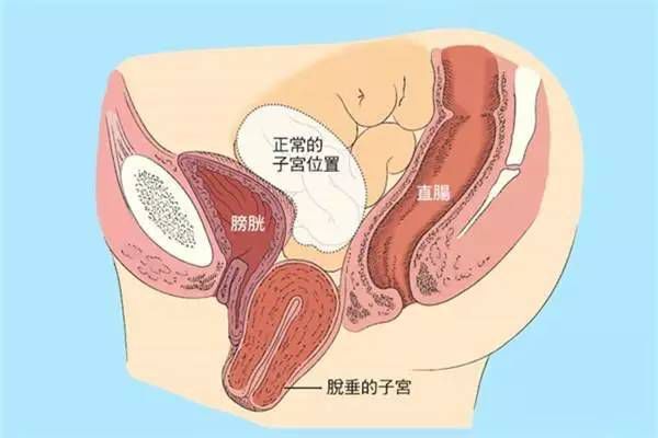 【產(chǎn)后修復(fù)】盆腔臟器脫垂，你有嗎？