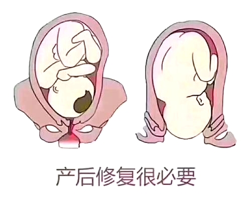 產(chǎn)后恢復(fù)項(xiàng)目好不好，兩大指標(biāo)尤為關(guān)鍵