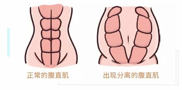 腹直肌修復(fù)電極，硅膠電極的特點(diǎn)