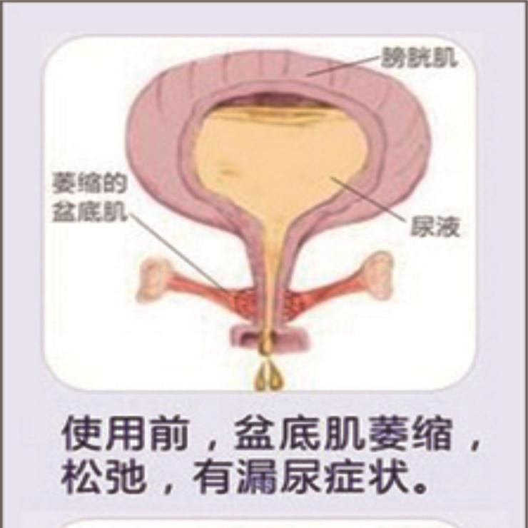 產(chǎn)后盆底肌康復(fù)|“社交癌”盯上你了嗎？