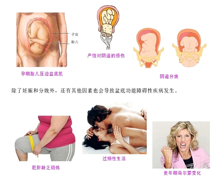 產(chǎn)后康復治療很重要，慢性盆腔痛很重要