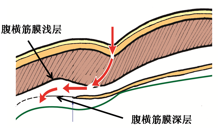 產(chǎn)后腹直肌分離如何康復(fù)，腹直肌修復(fù)那點事