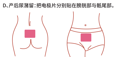 產(chǎn)后康復(fù)治療儀/仿生物電刺激治療產(chǎn)后尿潴留效果怎么樣？