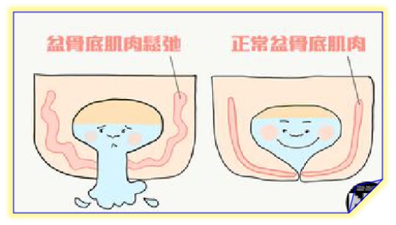 盆底康復治療怎么做，盆底肌修復常見的十大問題（中）