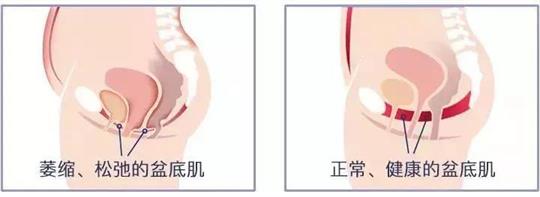 尿失禁治療儀器，不再詢問盆底康復(fù)治療有用嗎這類無意義問題