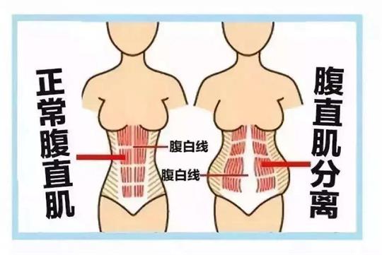 你所不知道的產(chǎn)后腹直肌如何康復(fù)，通澤產(chǎn)康為您解答