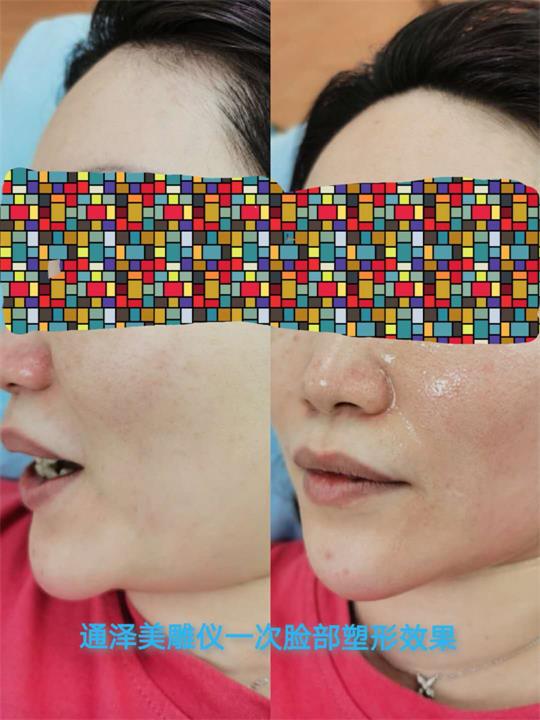 產(chǎn)后塑形溶脂瘦身儀器，美容院產(chǎn)康店的專(zhuān)用儀器