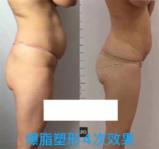 產(chǎn)后塑形美雕儀，生完孩子真的很難恢復(fù)身材？未必……