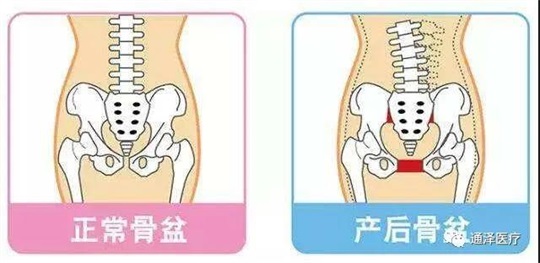 產(chǎn)后康復(fù)儀器能對(duì)骨盆產(chǎn)生康復(fù)鞏固作用嗎？答案肯定是可以的