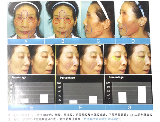 速get8D多極射頻美雕儀，保持年輕體態(tài)的好產(chǎn)品