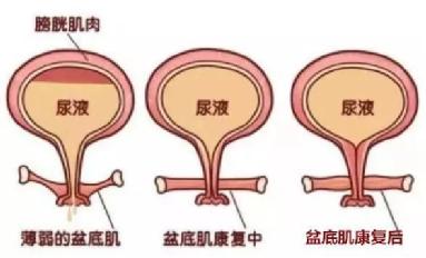 尿頻尿急尿不盡？或者可以試試盆底肌修復(fù)儀器電刺激