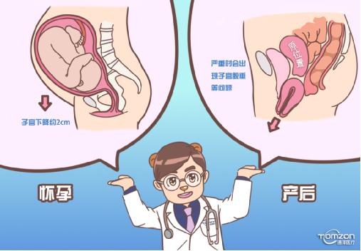 盆底康復治療儀可以解決子宮下降問題嗎？