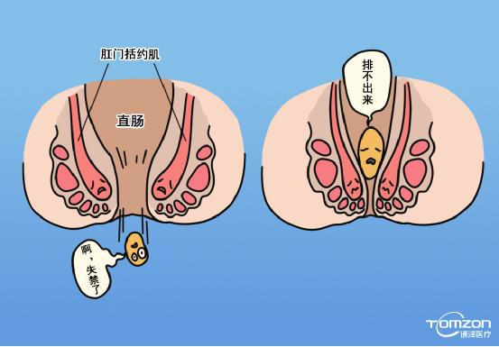 便秘跟盆底肌有什么關(guān)系，能用盆底肌修復(fù)儀器治療嗎？