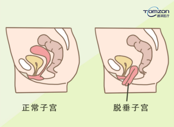 盆底康復(fù)治療儀能夠改善什么樣的情況？